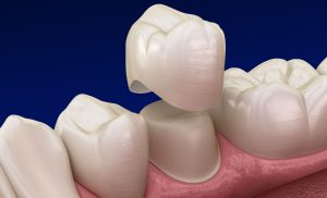 Crown - Tooth Replacement Surgery Franklin MI