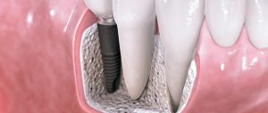 Affordable Dental Implants Bloomfield Hills MI