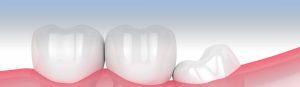 Wisdom Teeth - Tooth Replacement Surgery Farmington Hills MI